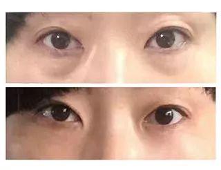 眼袋视频,跟随视频学习眼部护理之道