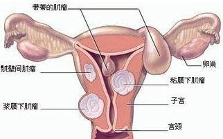 子宫后壁肌瘤图片,形态与特征解析